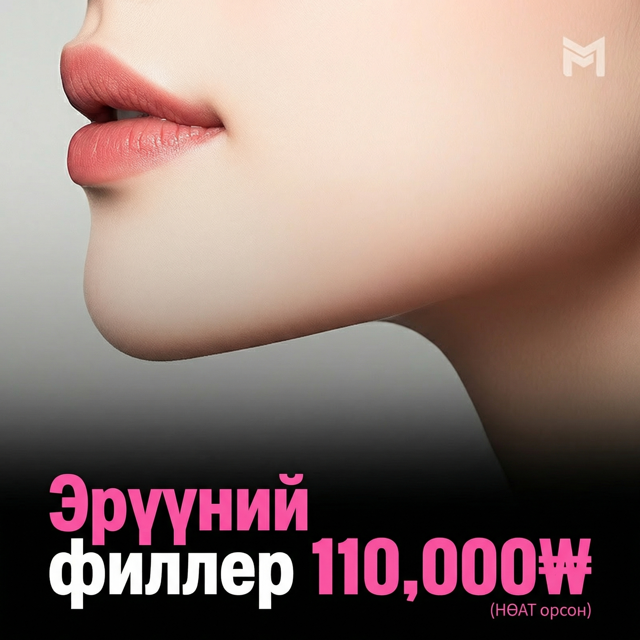 Нэмэлт төлбөргүй эрүүний филлер - Урд эрүү, V-лайн, орсгой амыг засах, эрүү дүүргэх