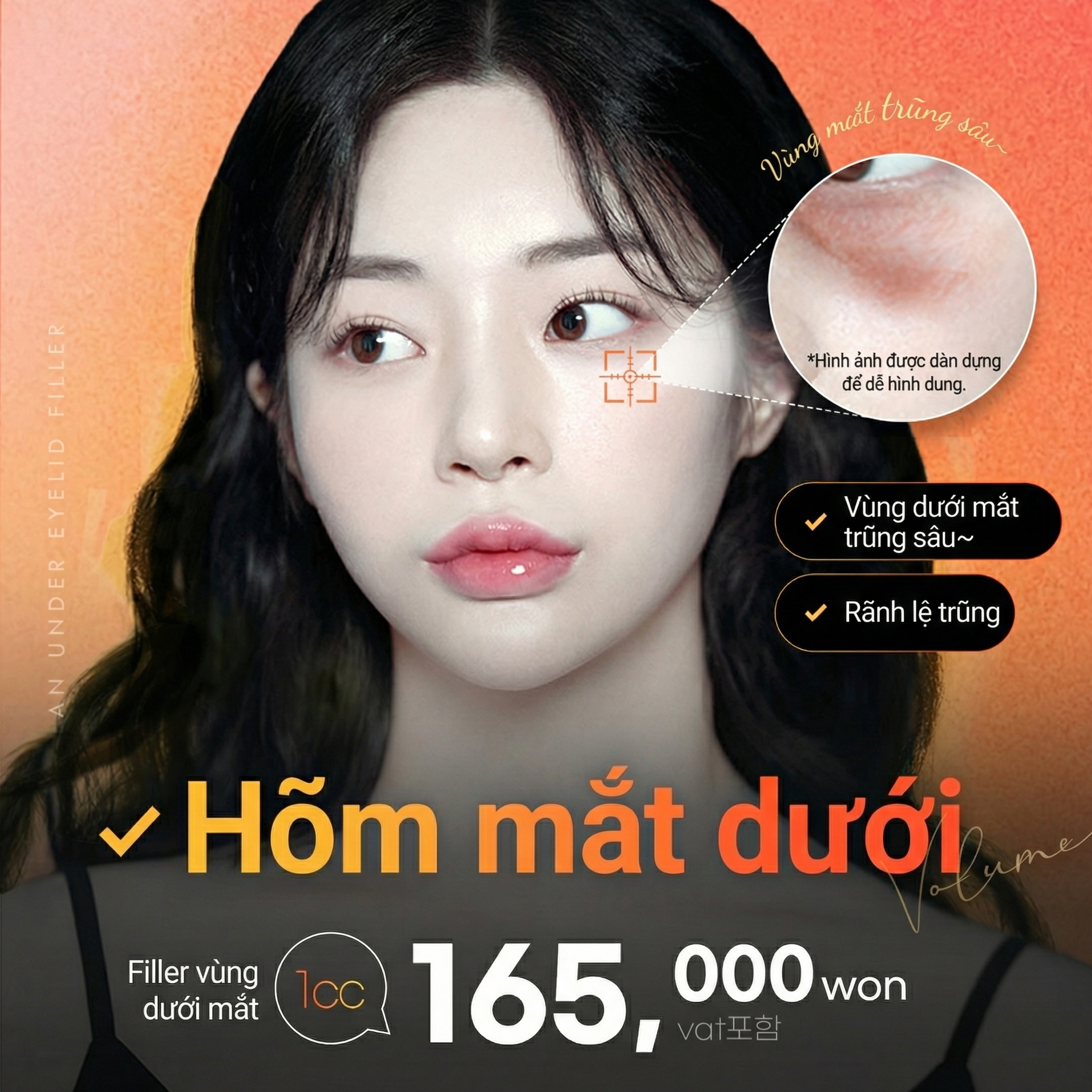 Filler làm đầy hốc mắt sâu, rãnh lệ