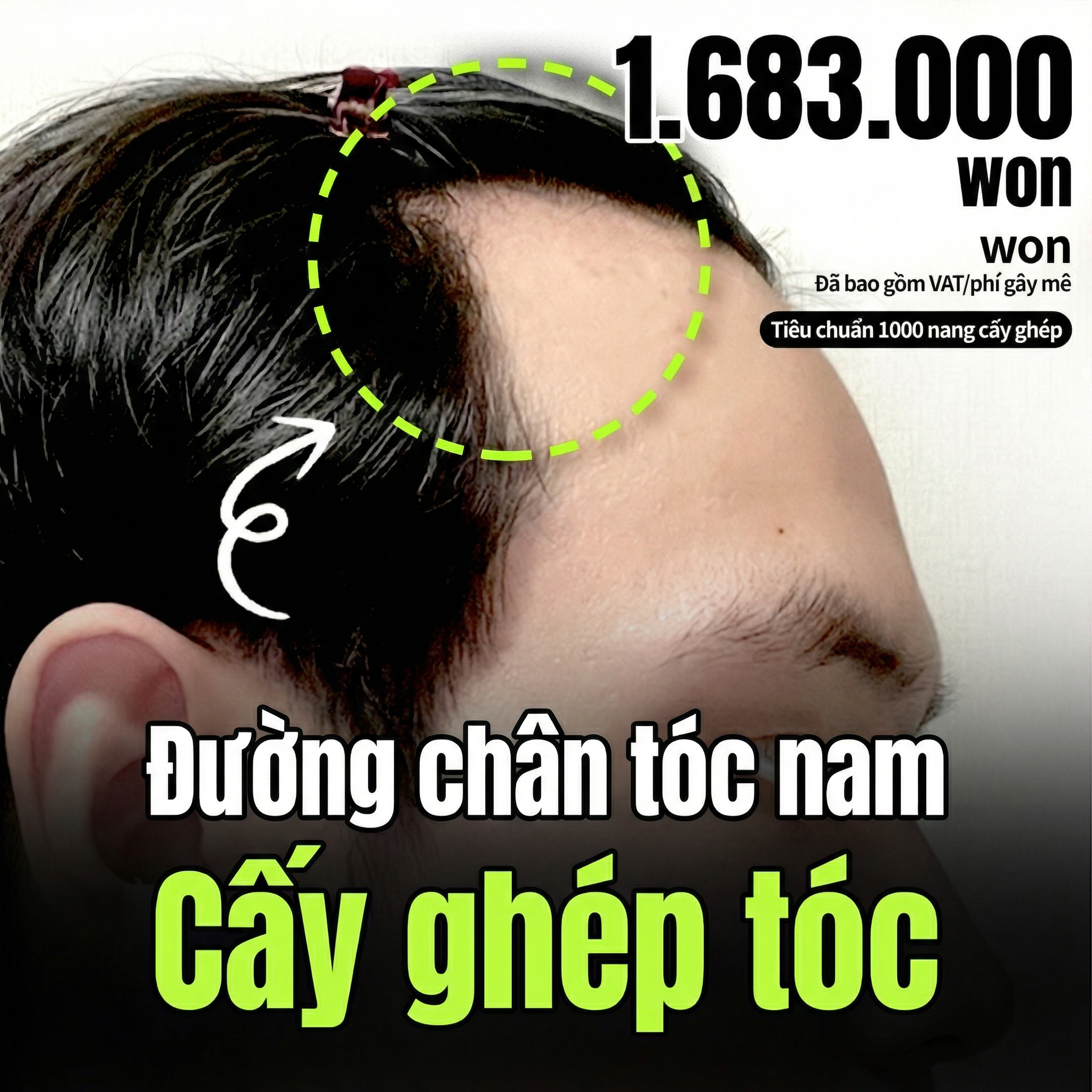 아이돌 헤어라인 모발이식