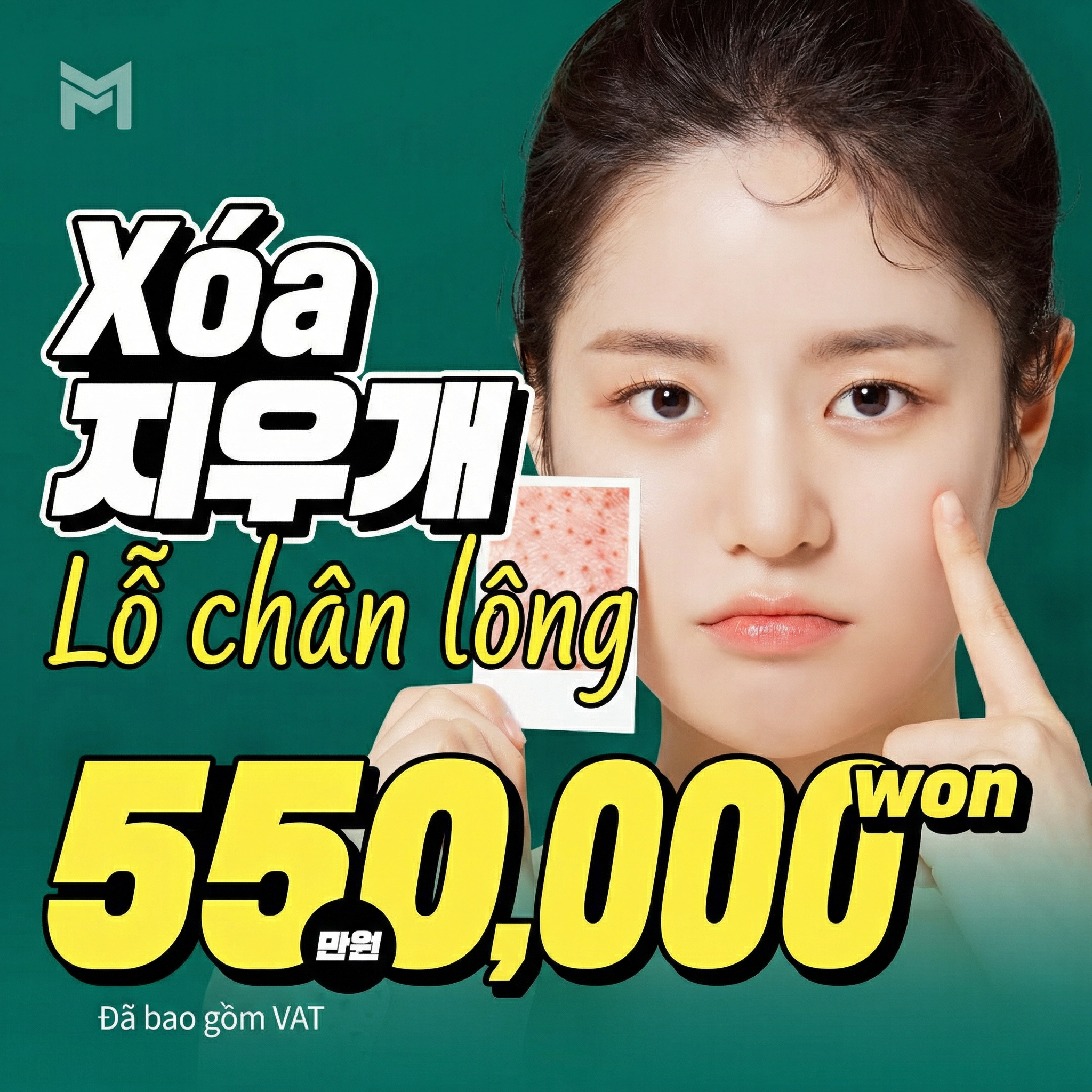 Potenza Laser & Juvelook Tẩy xóa lỗ chân lông - Thu nhỏ lỗ chân lông, cải thiện kết cấu da, tông da, nếp nhăn nhỏ. Có thể chọn Skin Booster